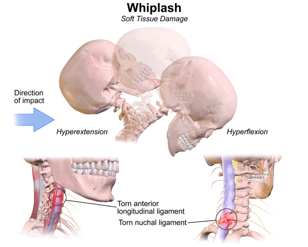 When and how whiplash injuries may occur. Soft tissue damage provoked from accident.