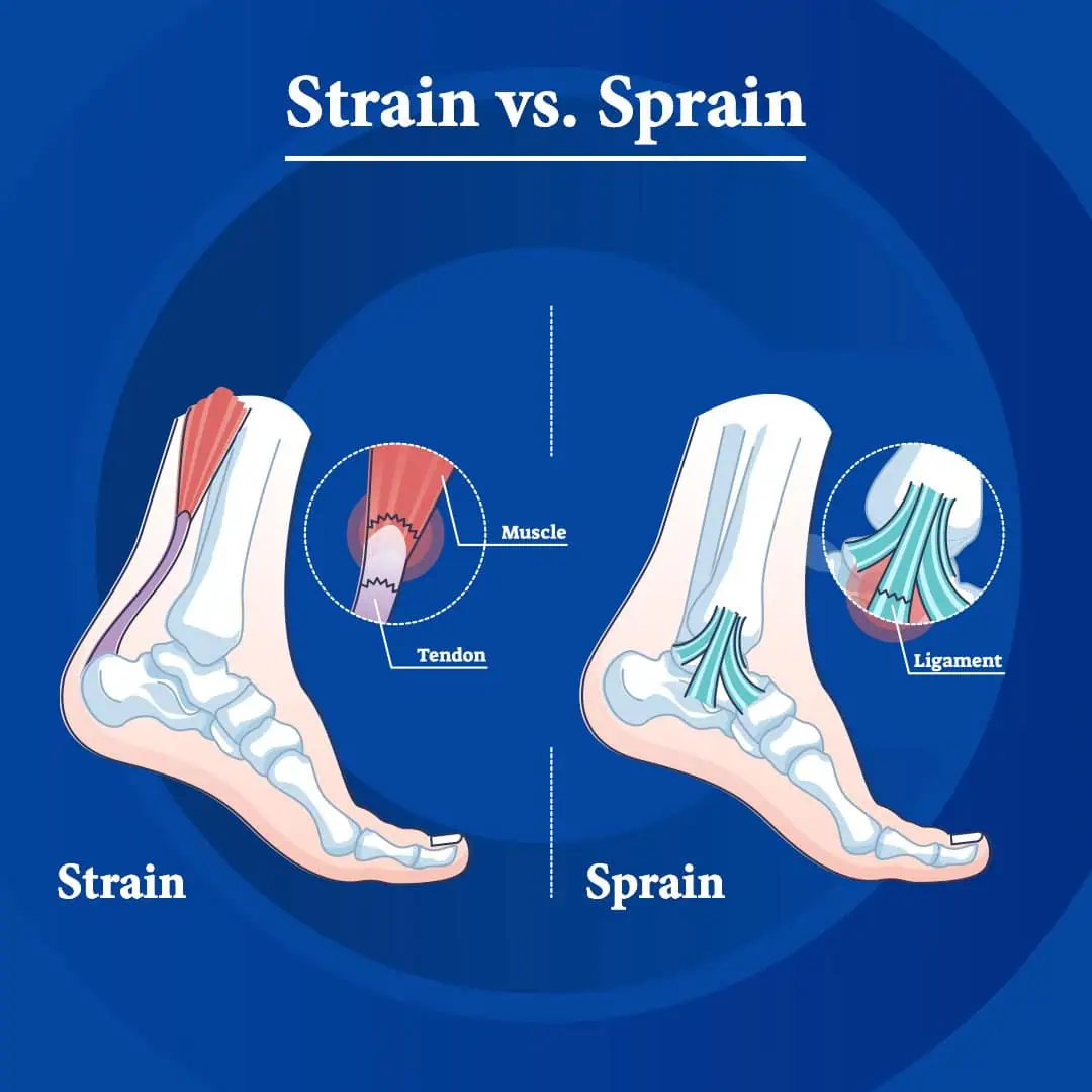 Sprain-vs-Strain